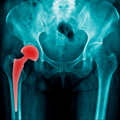 Hip Replacement Surgery in Guntur